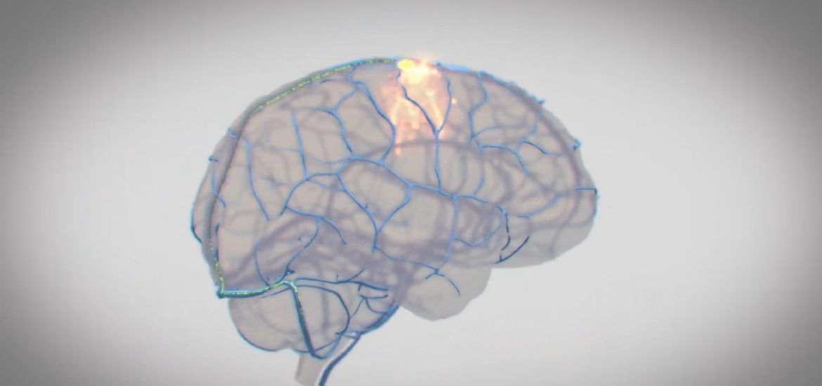 Synchron, konkurent Neuralinku, chce mozgovým implantátom liečiť Parkinsona
